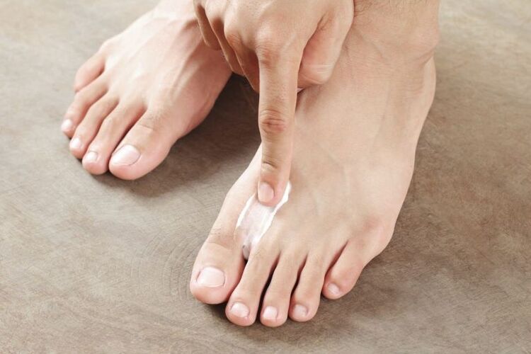 Antifungal kremin ayağın cildine uygulanması