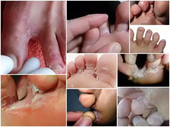 ayak parmakları arasında mantar belirtileri fotoğraf 1